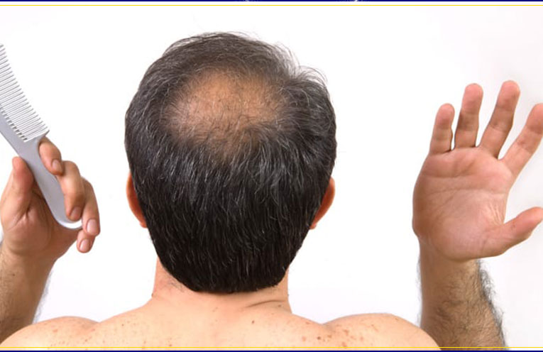 Hair loss